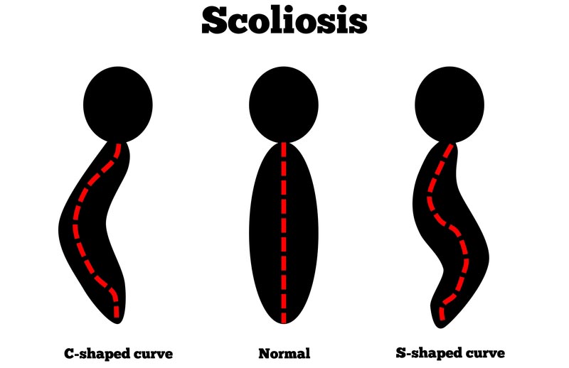 Aloha, Oregon scoliosis treatment